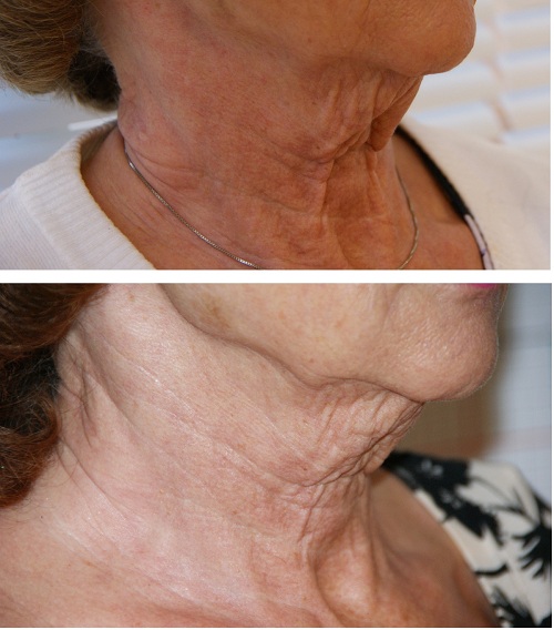 Cellulite behandling av halsen