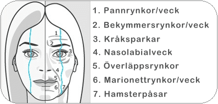 Områden på ansiktet som kan korrigeras med hjälp av botox.